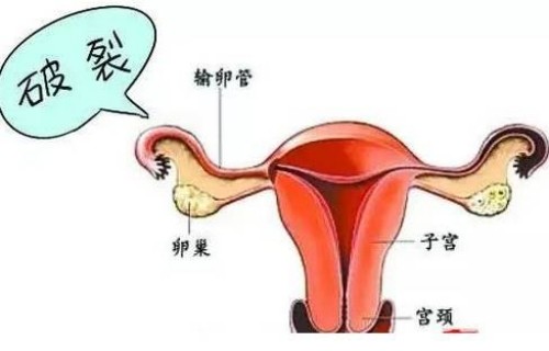 广州助孕：这些因素是近视的主要原因，做好这些预防措施能有效防止近视